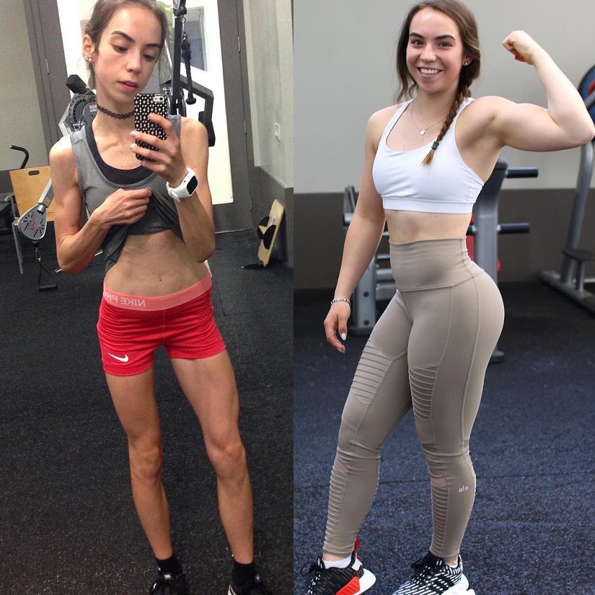 Kenzie Forbes awesome photo comparison of her before and after anorexia